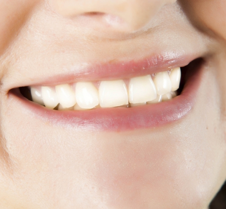 Teeth So White Cosmetic Teeth Whitening Leeds